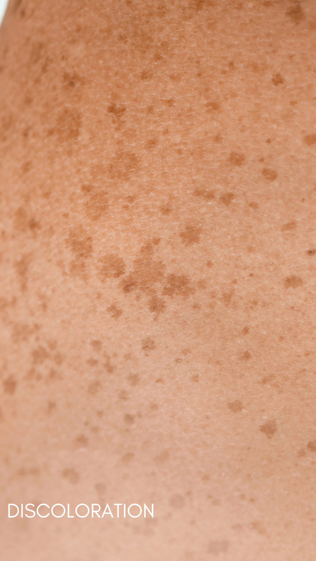 Hyperpigmentation / Darkspots